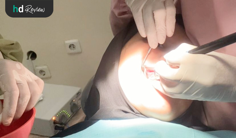 Review Gingivektomi di JB Dental Clinic, Atasi Gusi Perih saat Makan, operasi gusi, potong gusi, pemotongan gusi