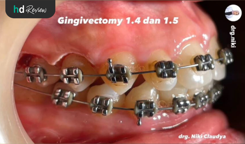 Review Gingivektomi di JB Dental Clinic, Atasi Gusi Perih saat Makan, operasi gusi, potong gusi, pemotongan gusi