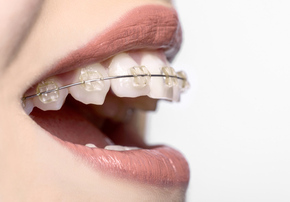 Clear Damon Braces dengan Drg. Sp Ort 1x di Dentistique Clinic