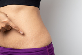 Triple Proionic Anti Stretch Mark Treatment by Indiba 1 kali dengan INDIBA di Genese Clinic