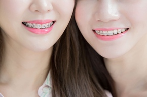 Pemasangan kawat gigi (Metal) 1x di Schon Dental