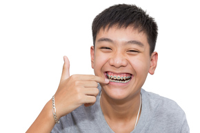Braces Treatment (metal) simple include Pembersihan karang gigi dan pencetakan +1 kali di Upstairs Dental Clinic