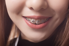 Ortho / Kawat Gigi Sapphire Braces di AM Dental Care