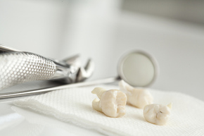 Odontectomy / Wisdom Tooth Removal di Dentistique Clinic