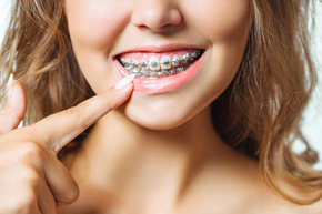 Pemasangan Kawat Gigi 1x di Dentist & Dentists