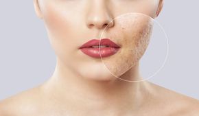 Paket Bye Acne Scar 1x di Klinik Estetik Ambrosia