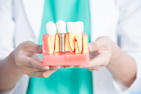 Implant per gigi 1x di dentist & dentists