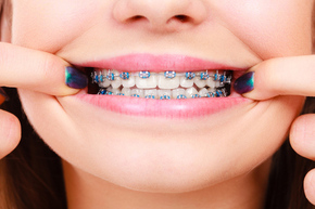 Ortho Metal dengan Drg. Sp Ort 1x di SDC Dental
