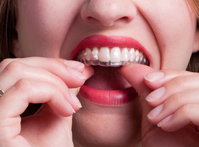 A Pair of Clear (Essix) Retainer di Dentistique Clinic
