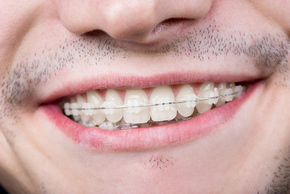 Pemasangan Behel/Bracket Ceramic 1x di Champion Dental Care