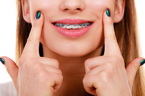 Pemasangan behel / Metal Braces from America + APD 1x di My Dental Studio