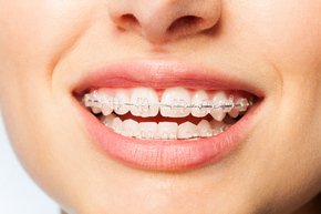 Pemasangan behel / Ceramic Braces from America + APD 1x di My Dental Studio