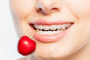 Pemasangan behel / Sapphire Braces from America + APD 1x di My Dental Studio