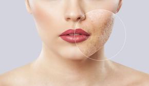 Insta Acne Scars Restoration 1x treatment di Insta Beauty Center