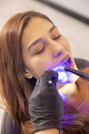 Tambal 4 gigi fissure sealant di Mydentismile
