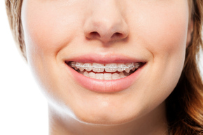 Pemasangan kawat gigi Clear 1x di Mydentismile