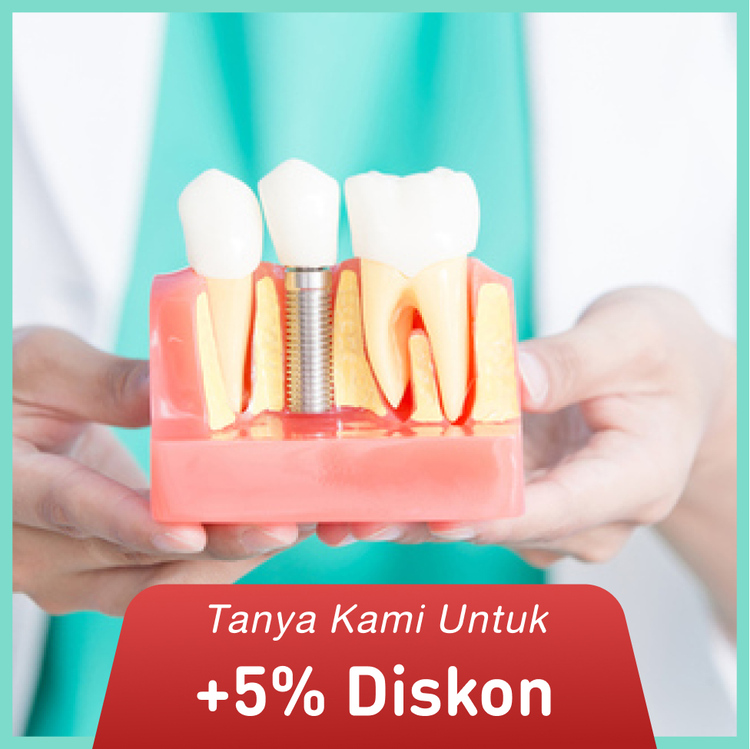 Implant per gigi 1x di dentist & dentists