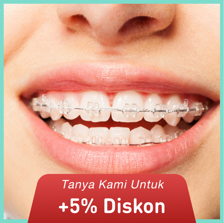 Pemasangan behel / Ceramic Braces from America + APD 1x di My Dental Studio