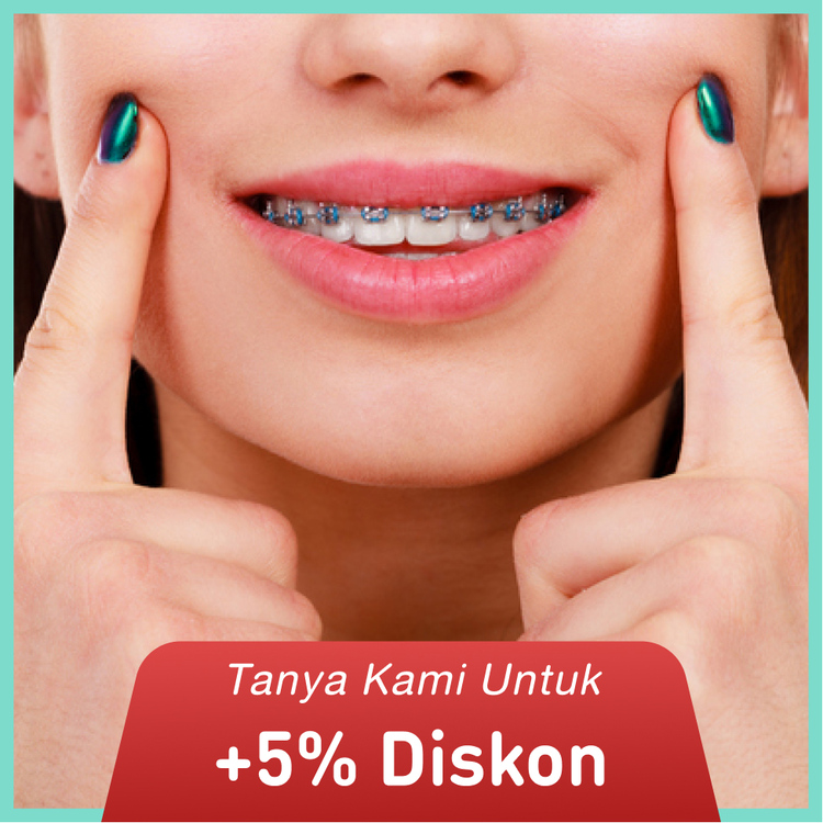 Pemasangan behel / Metal Braces from America + APD 1x di My Dental Studio
