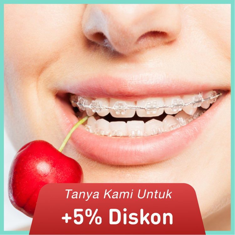 Pemasangan behel / Sapphire Braces from America + APD 1x di My Dental Studio