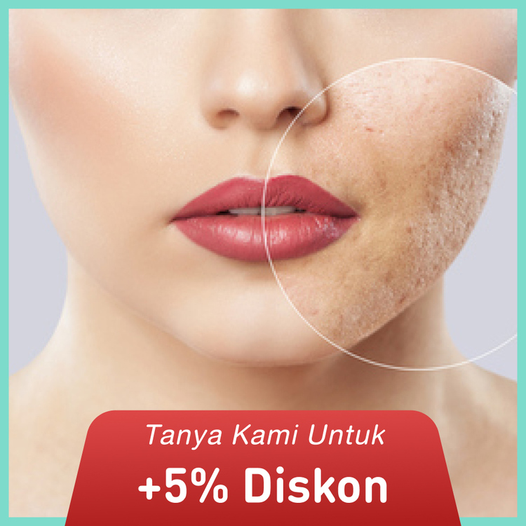 Paket Bye Acne Scar 1x di Klinik Estetik Ambrosia