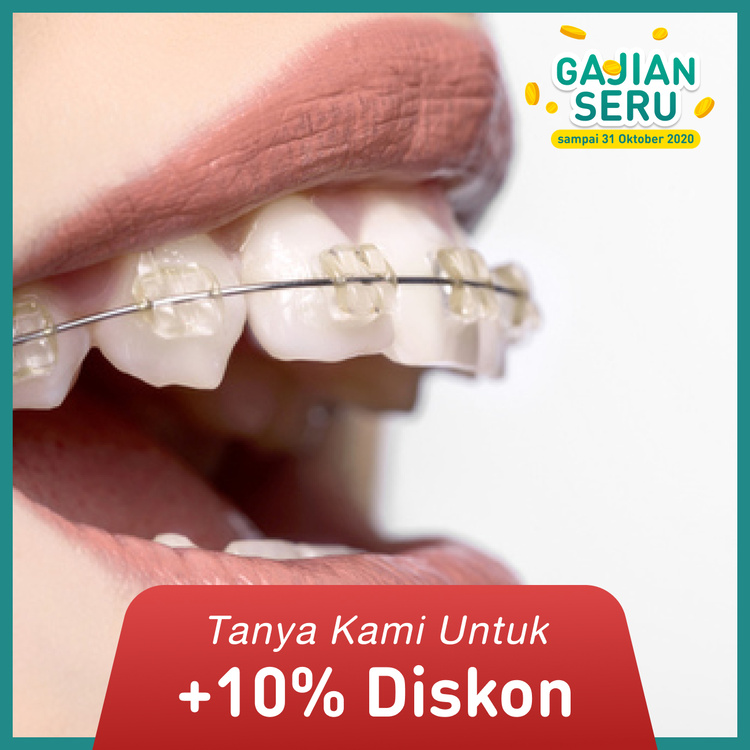 Clear Damon Braces dengan Drg. Sp Ort 1x di Dentistique Clinic