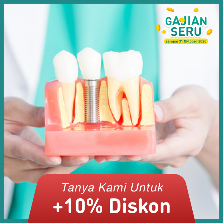 Implant per gigi 1x di dentist & dentists