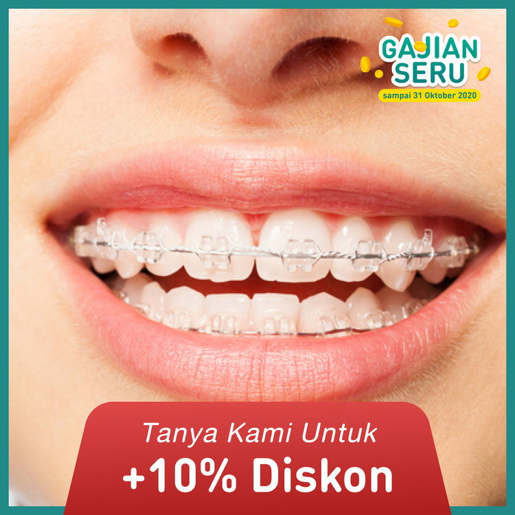 Pemasangan behel / Ceramic Braces from America + APD 1x di My Dental Studio