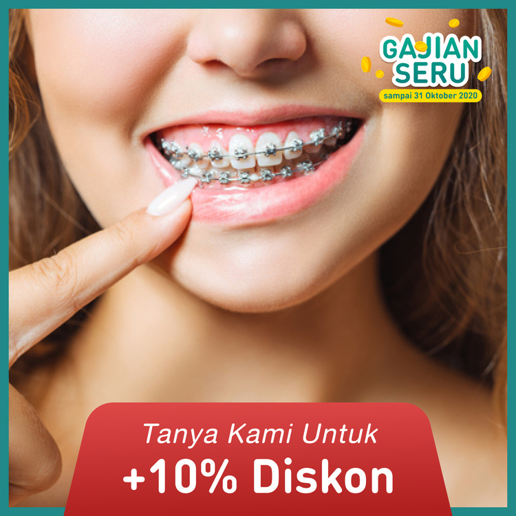 Pemasangan Kawat Gigi (Bracket Metal) + Pembersihan karang gigi + Konsultasi di FD Care
