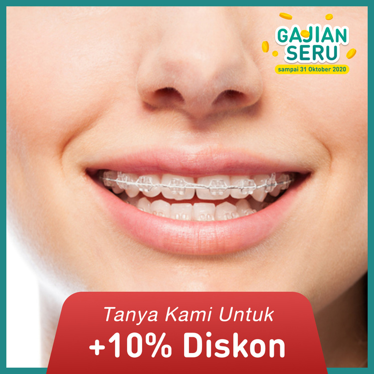 Pemasangan kawat gigi Clear 1x di Mydentismile
