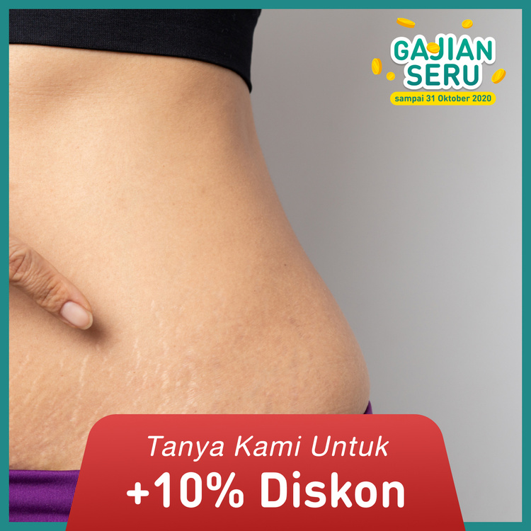 Triple Proionic Anti Stretch Mark Treatment by Indiba 1 kali dengan INDIBA di Genese Clinic
