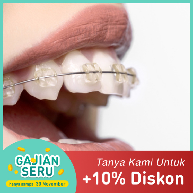 Clear Damon Braces dengan Drg. Sp Ort 1x di Dentistique Clinic