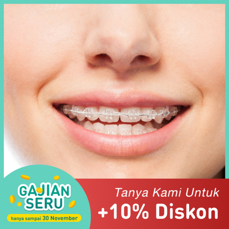 Pemasangan kawat gigi Clear 1x di Mydentismile