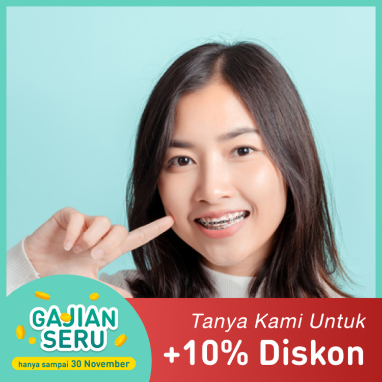 Pemasangan kawat gigi Metal 1x di Mydentismile