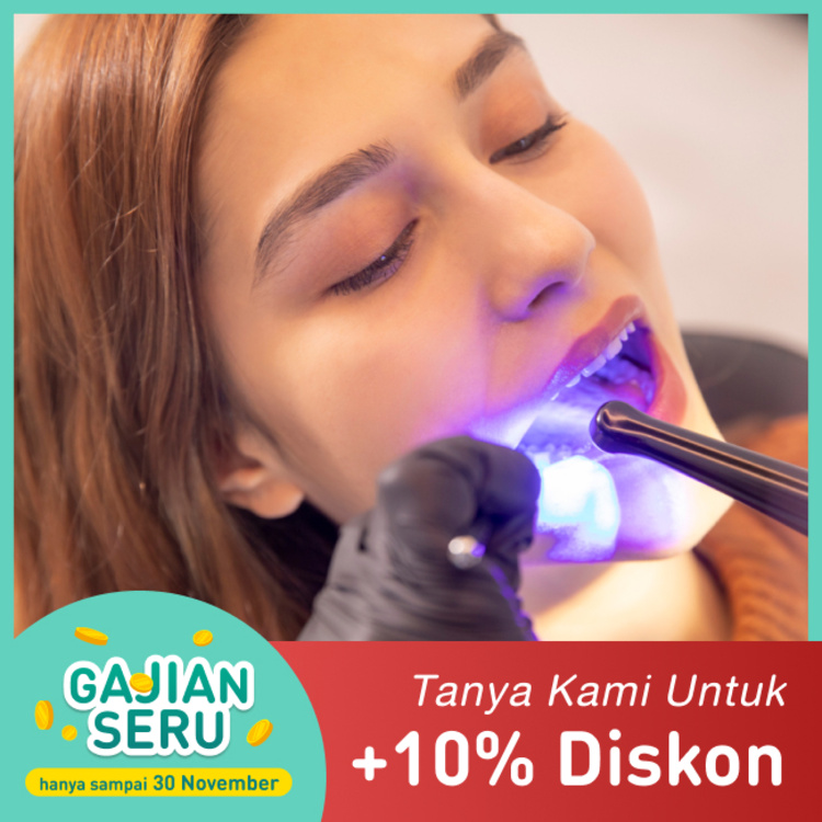Tambal 4 gigi fissure sealant di Mydentismile