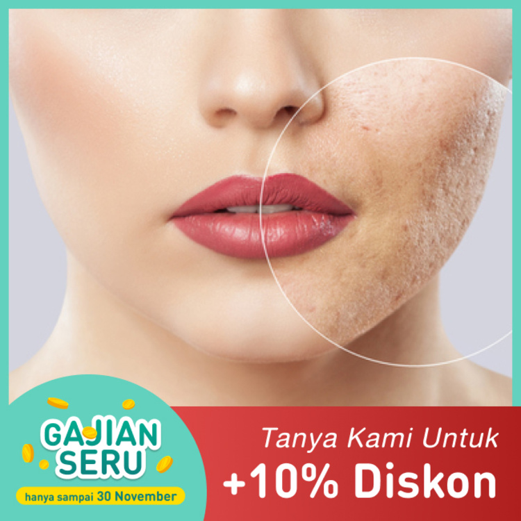 Insta Acne Scars Restoration 1x treatment di Insta Beauty Center