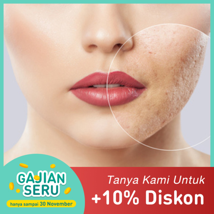 Paket Bye Acne Scar 1x di Klinik Estetik Ambrosia