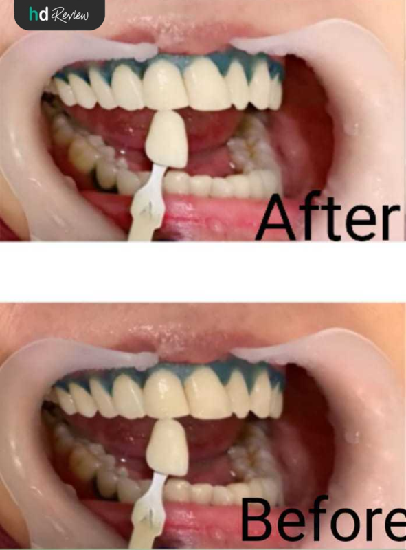 Review Bleaching Gigi di Klinik Gigi drg. Mia, memutihkan gigi, mencerahkan gigi