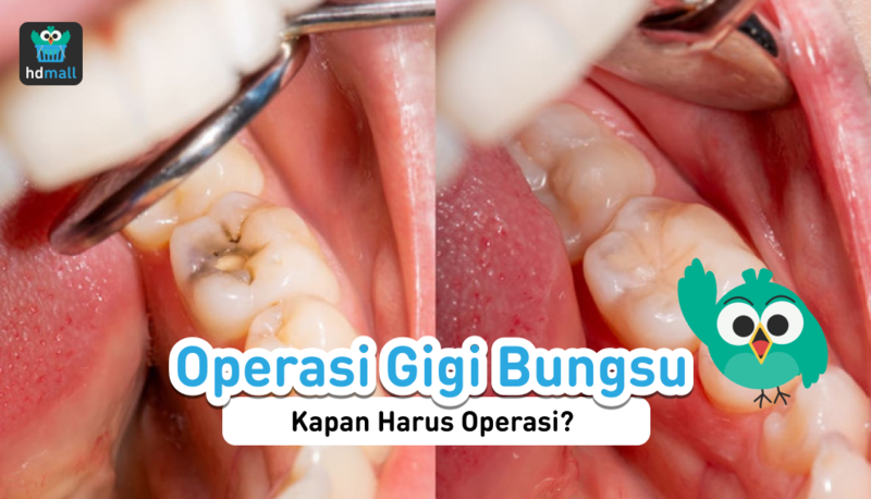 Operasi Gigi Bungsu