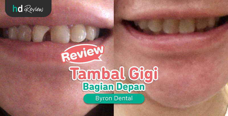 Review Tambal Gigi Depan di Byron Dental