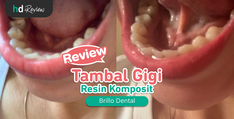 Review Tambal Gigi di Brillo Dental
