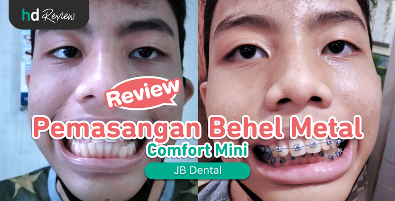 Review Pemasangan Behel Metal Comfort Mini di JB Dental