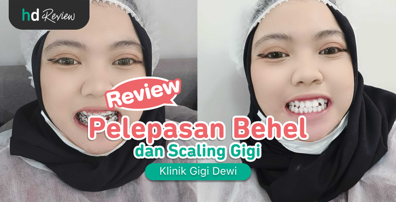 Review Pelepasan Behel di Klinik Gigi Dewi