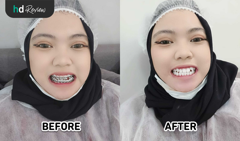 Hasil Pelepasan Behel di Klinik Gigi Dewi