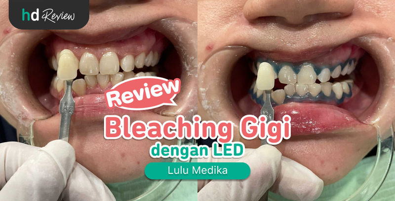 Review Bleaching Gigi di Lulu Medika