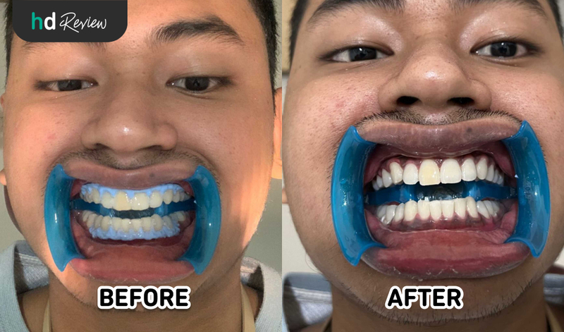 Hasil Bleaching Gigi di Difa Oral Health Care