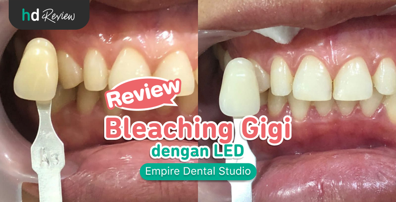 Review Bleaching Gigi di Empire Dental Studio