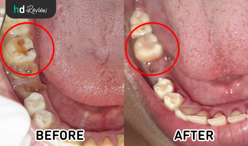 Hasil Tambal Gigi di Byron Dental