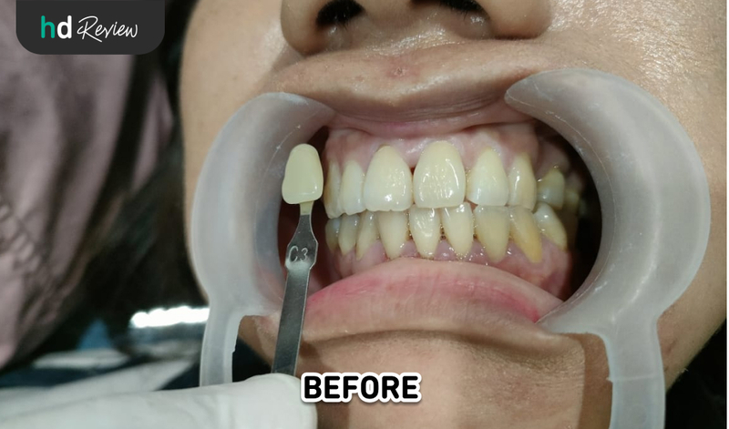 Sebelum Bleaching Gigi di AM Dental Care