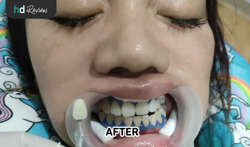 Setelah Bleaching Gigi di AM Dental Care